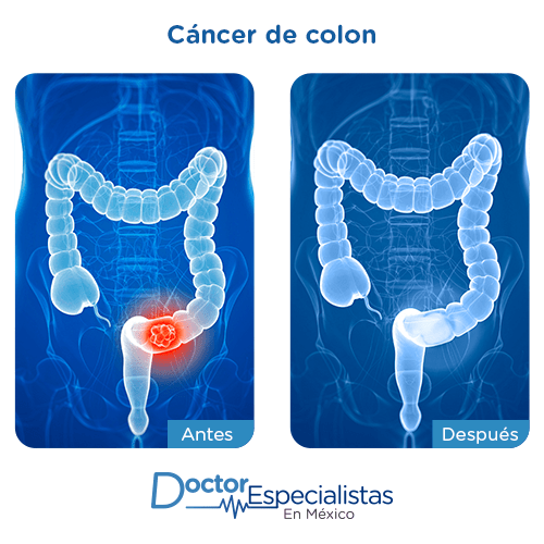 Cancer de colon imagen ilustrativa
