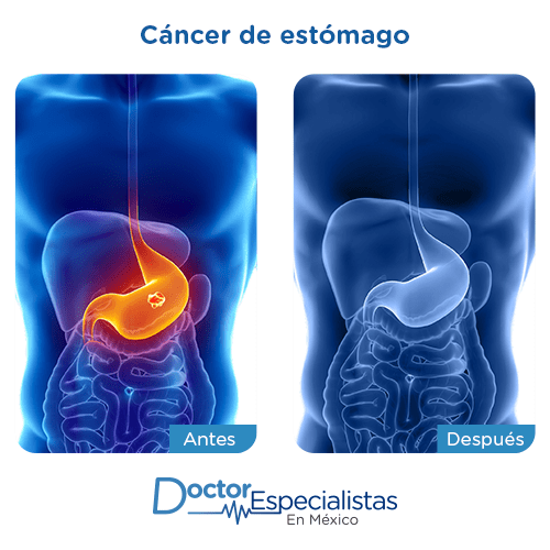 Cancer de estomago imagen ilustrativa