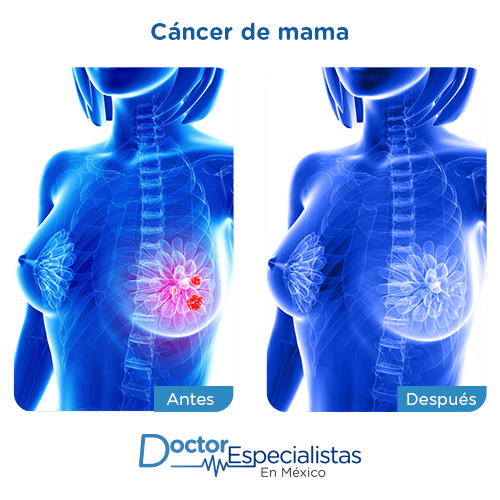 Cancer de mama imagen ilustrativa