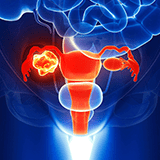 Imagen ilustrativa de cancer de ovario