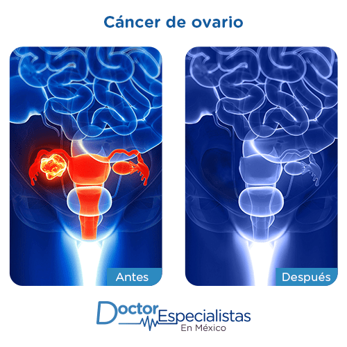 Cancer de ovario imagen ilustrativa