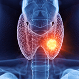 Imagen ilustrativa de cancer de tiroides 
