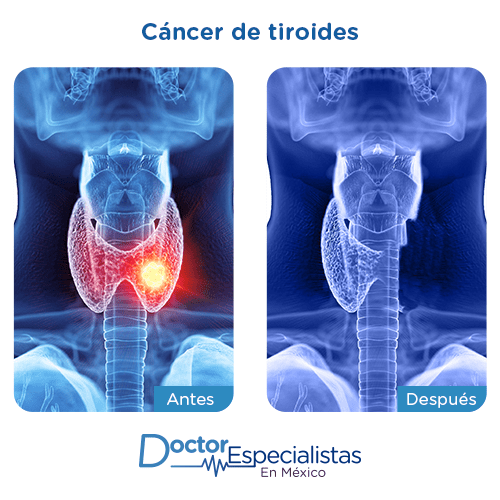 Cancer de tiroides imagen ilustrativa