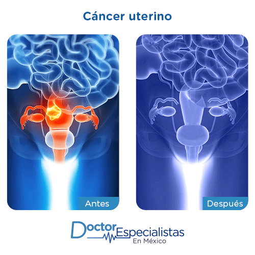 Cancer uterino imagen ilustrativa