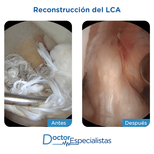 Reconstrucción del LCA antes y despues