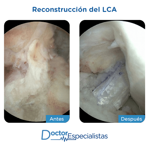 Reconstrucción del LCA antes y despues