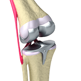 Imagen ilustrativa de un reemplazo de rodilla