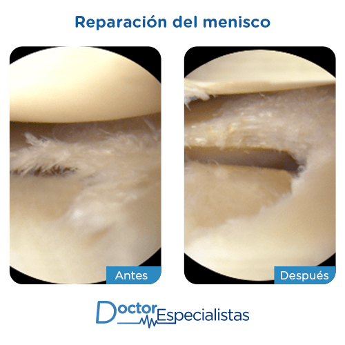 Reparación del menisco antes y despues