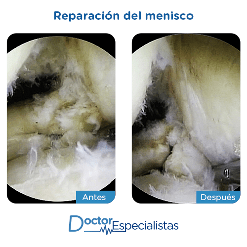 Reparación del menisco antes y despues