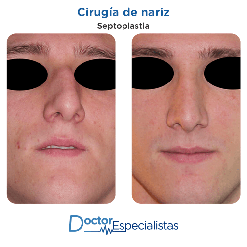 Cirugia de nariz antes y despues