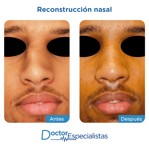 Reconstruccion nasal antes y despues