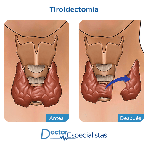 Tiroidectomia imagen ilustrativa