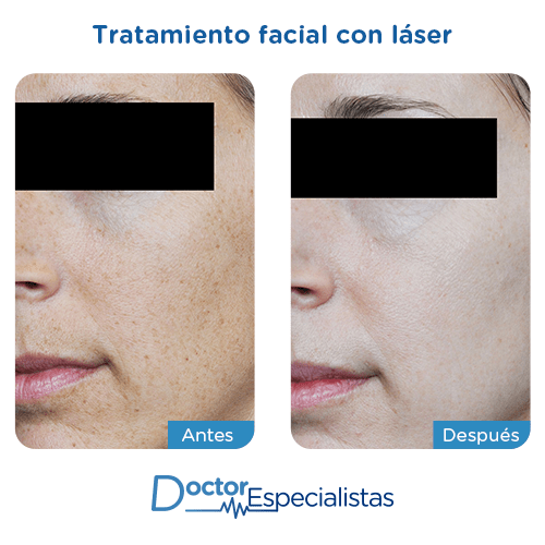 Tratamiento facial laser antes y despues