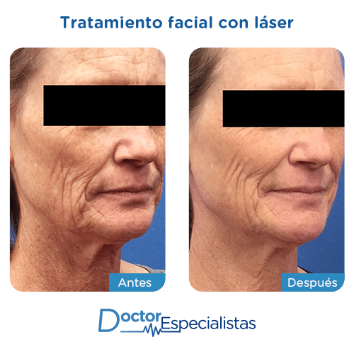 Tratamiento facial laser antes y despues