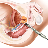 Imagen ilustrativa de Biopsia de próstata