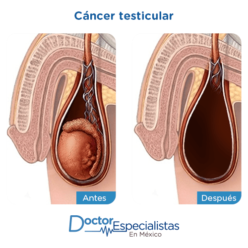 Cancer testicular imagen ilustrativa