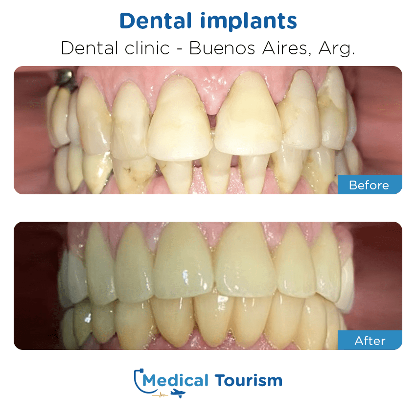 Paciente Dentista Ciudad de México antes y despues