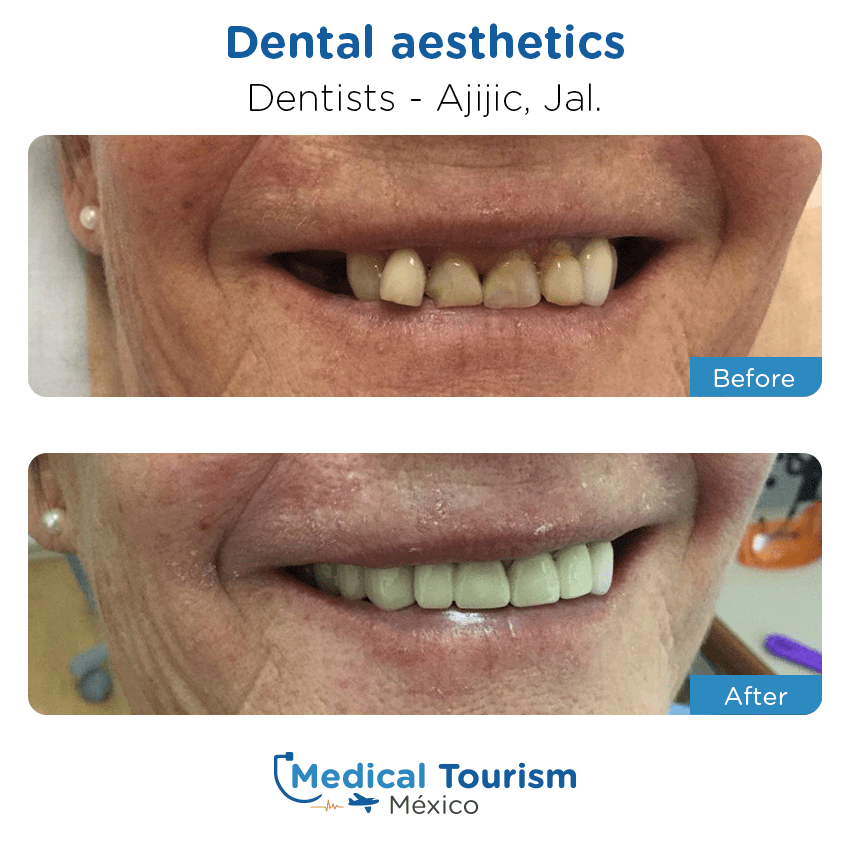 Paciente dentista
                                         Ajijic antes y despues