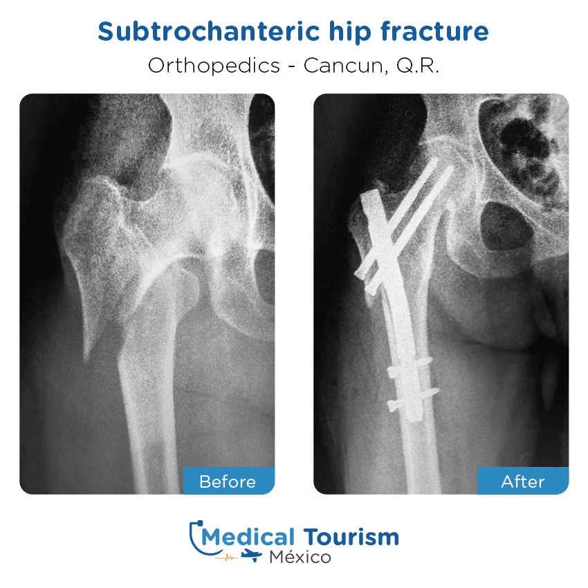 Paciente ortopedia
                                         Cancún antes y despues