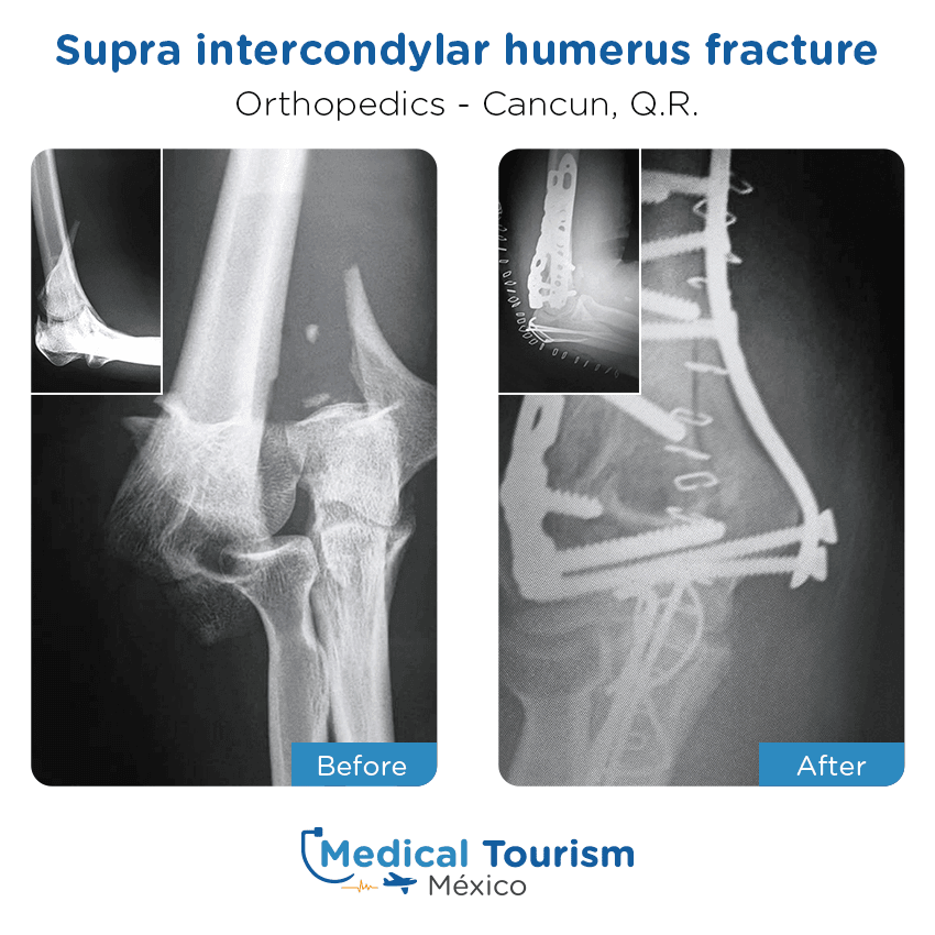 Paciente ortopedia
                                         Cancún antes y despues