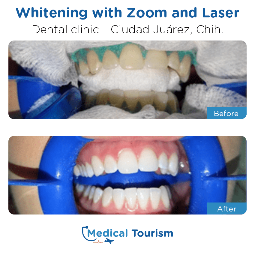 Paciente dentista Ciudad Juarez antes y despues