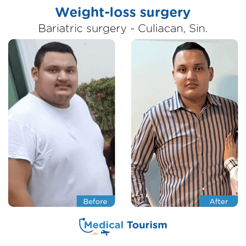 Paciente cirugía bariátrica Culiacán antes y despues