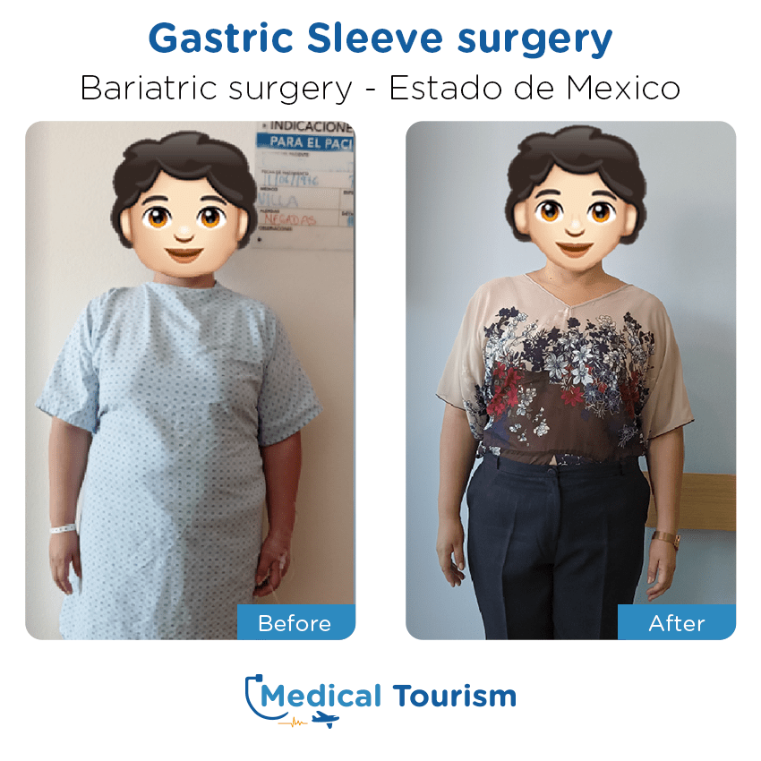 Paciente cirugía bariátrica estado de México antes y despues
