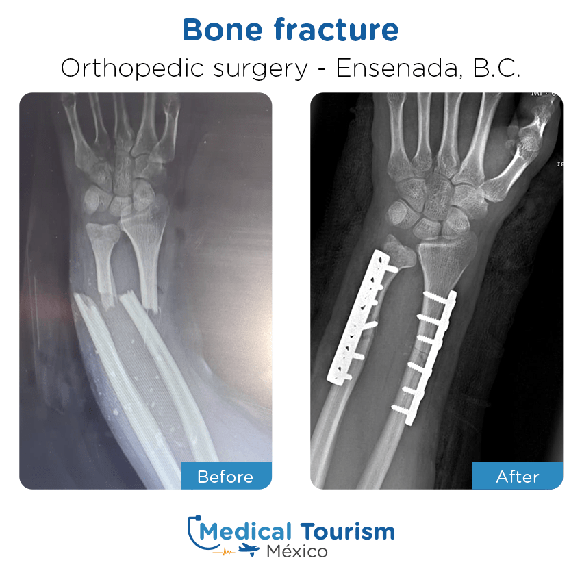 Paciente ortopedia
                                         Ensenada antes y despues