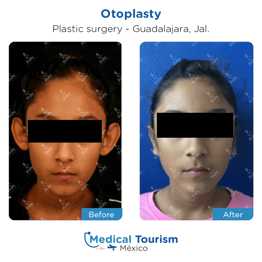 Paciente cirugía plástica Guadalajara antes y despues