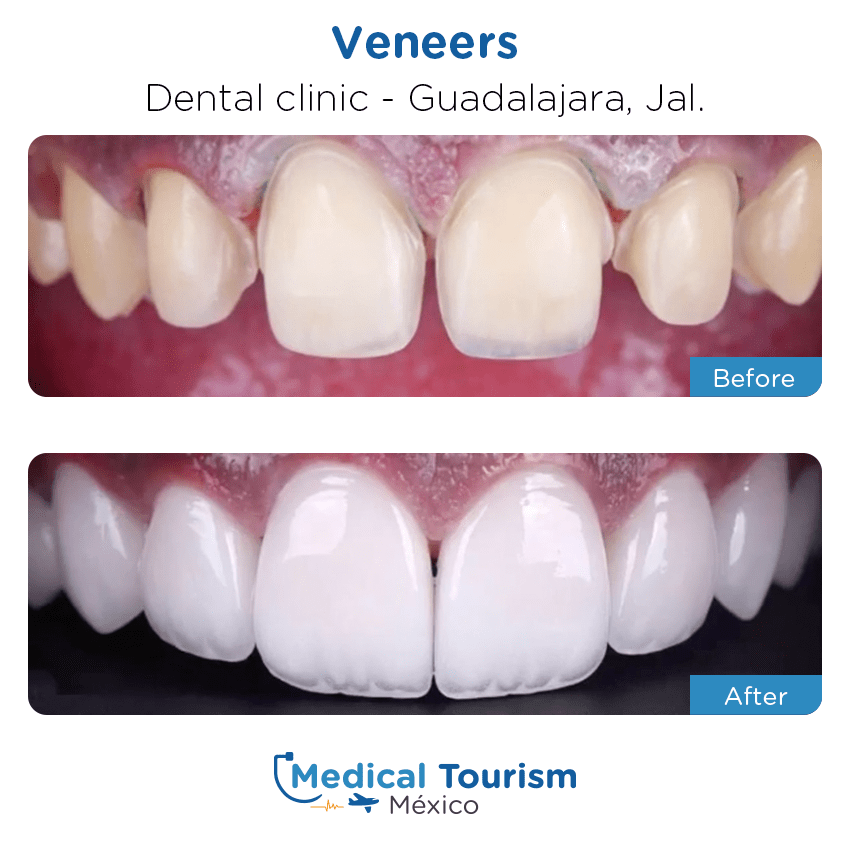Paciente dentista Guadalajara antes y despues