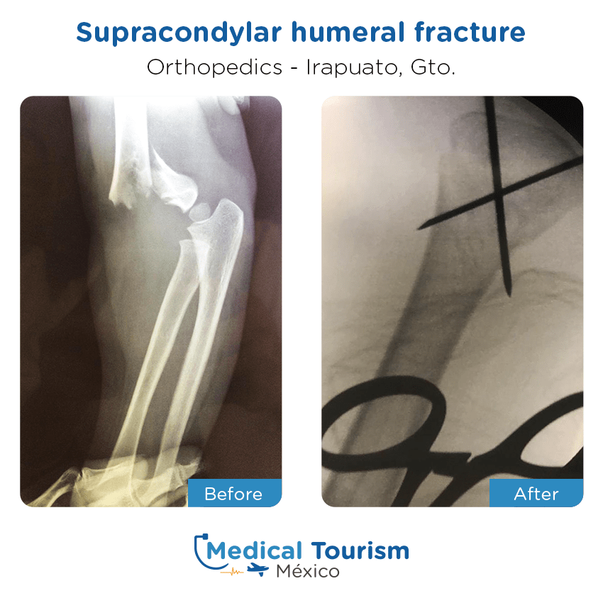 Paciente ortopedia
                                         Irapuato antes y despues