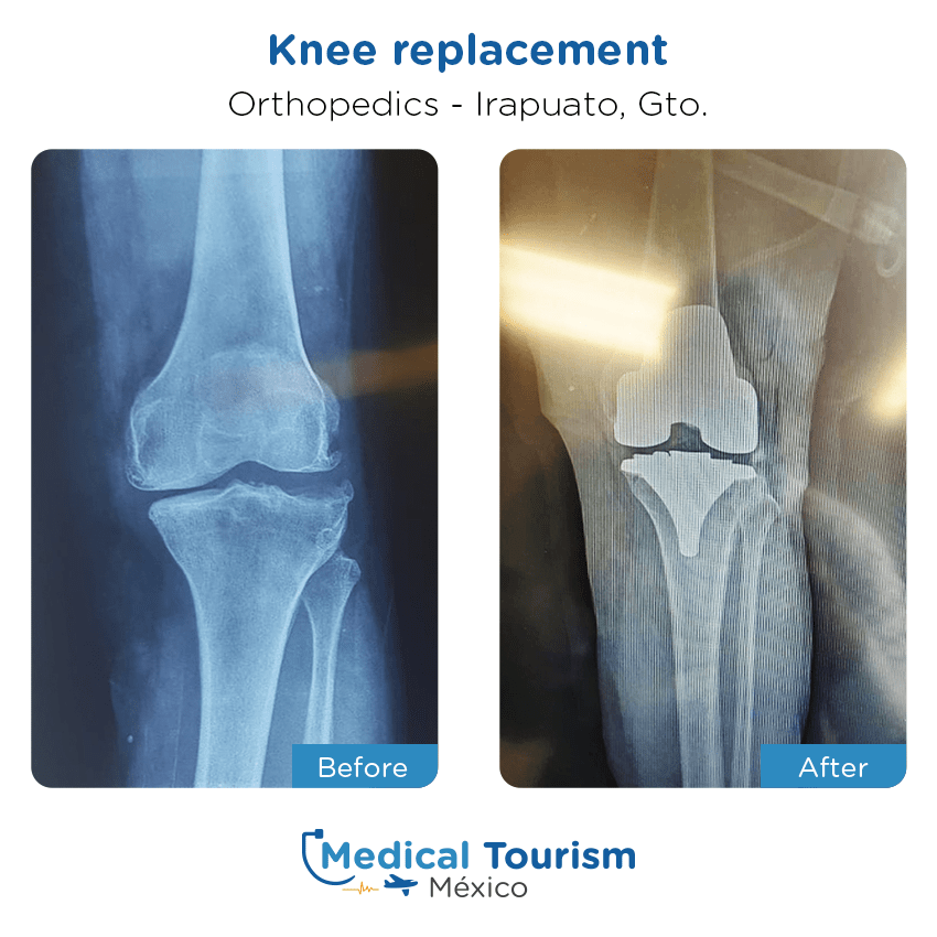Paciente ortopedia
                                         Irapuato antes y despues