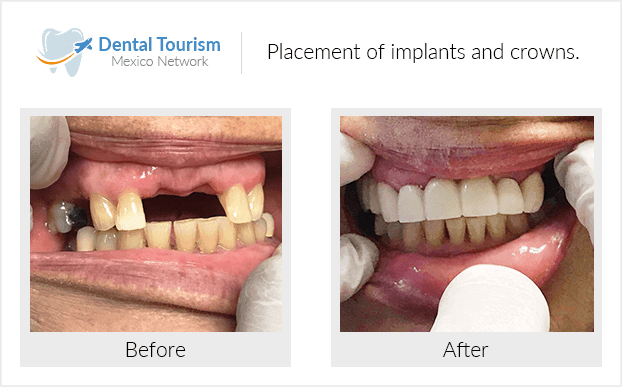 Paciente dentista
                                         Los Algodones antes y despues