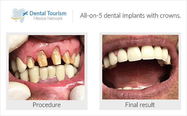 Paciente dentista Los Algodones antes y despues