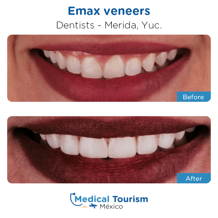 Paciente dentista Mérida antes y despues