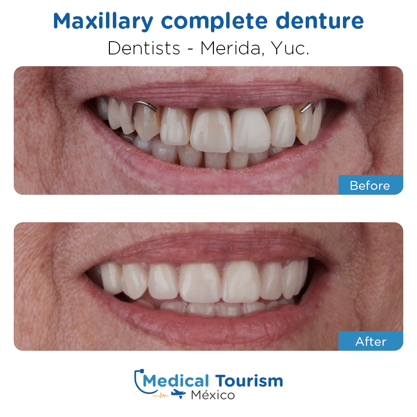 Paciente dentista Mérida antes y despues