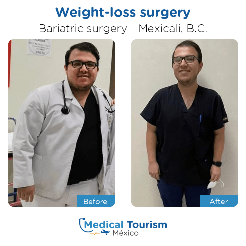 Paciente cirugía bariátrica Mexicali antes y despues