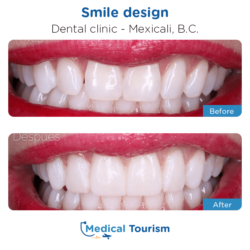 Paciente dentista Mexicali antes y despues
