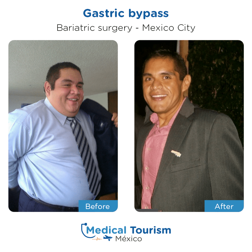 Paciente cirugía bariátrica
                                         Ciudad de México antes y despues