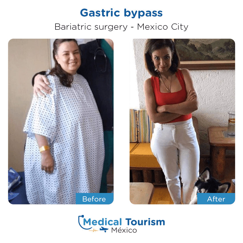 Paciente cirugía bariátrica Ciudad de México antes y despues