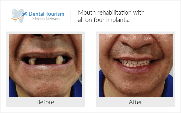 Paciente dentista Ciudad de México antes y despues