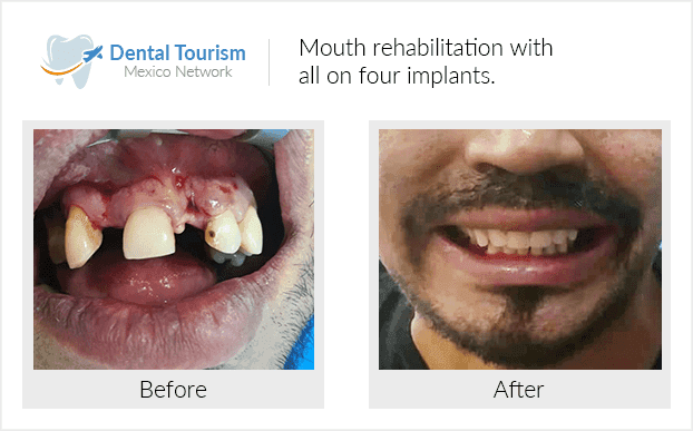 Paciente dentista Ciudad de México antes y despues