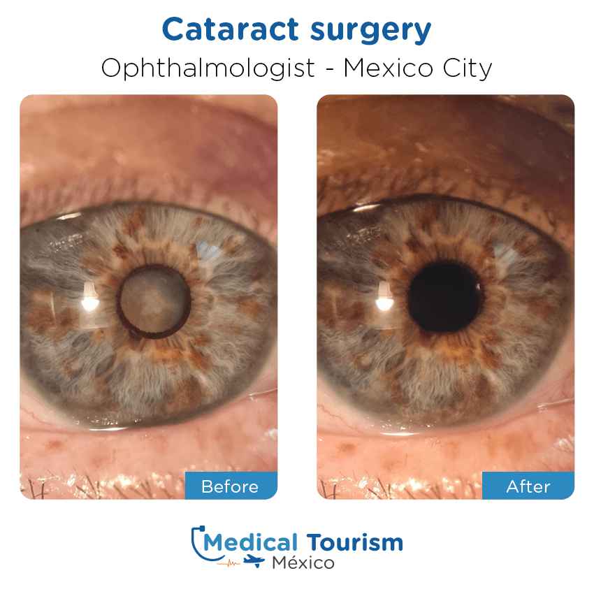 Paciente oftalmología Ciudad de México antes y despues