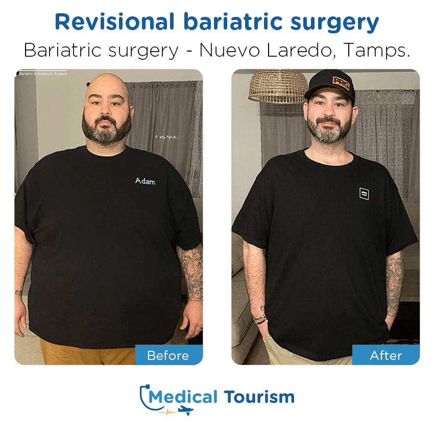 Paciente cirugía bariátrica Nuevo Laredo antes y despues