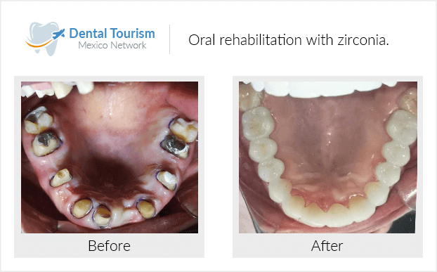 Paciente dentista Oaxaca antes y despues