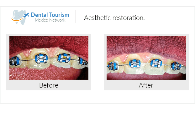 Paciente dentista Oaxaca antes y despues