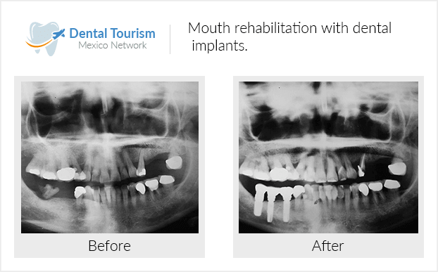 Paciente dentista Piedras Negras antes y despues