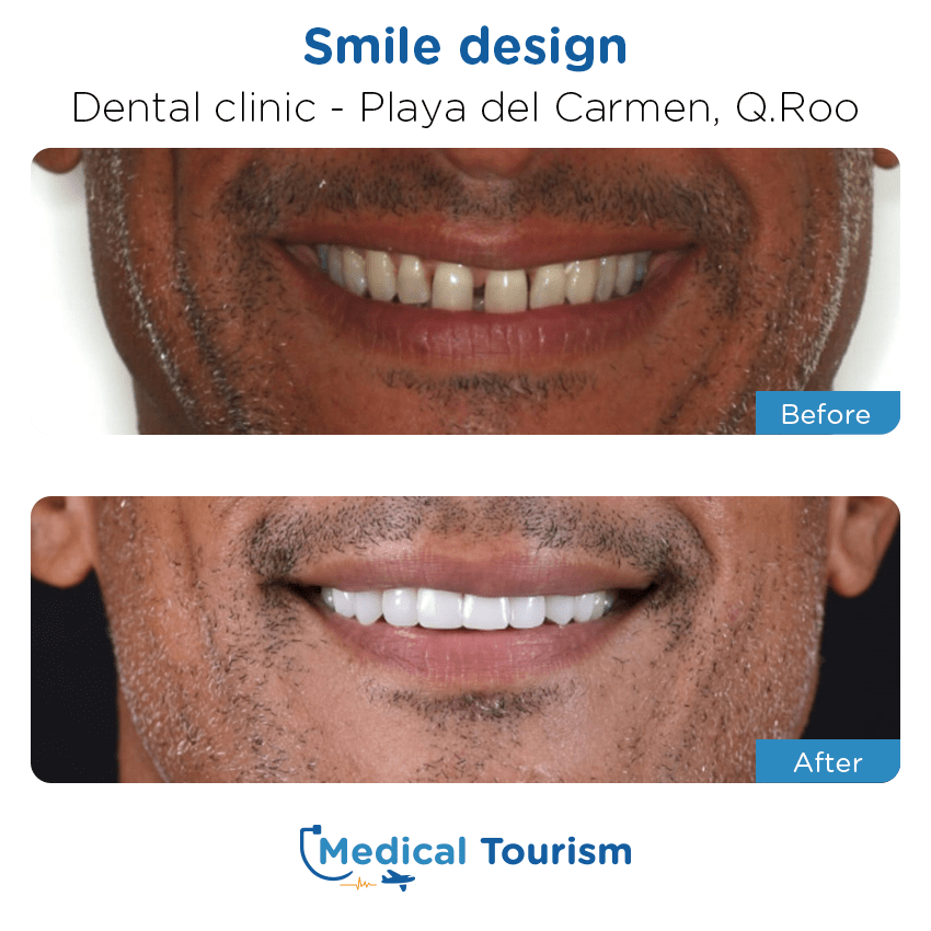 Paciente Dentista Ciudad de México antes y despues