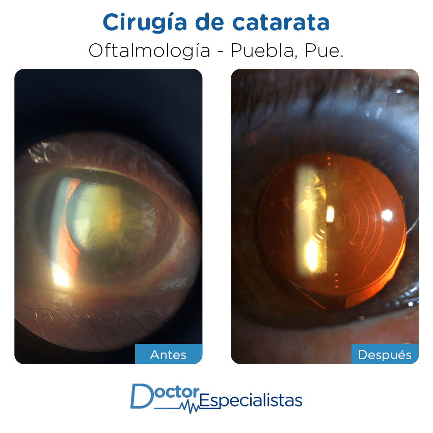 Paciente oftalmología Puebla antes y despues