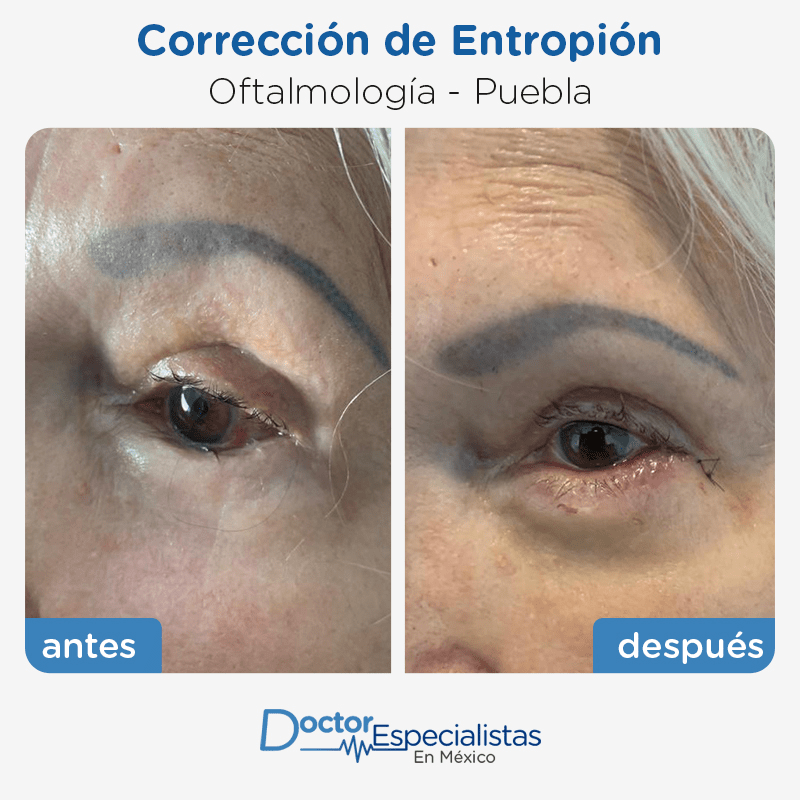 Paciente oftalmología Puebla antes y despues